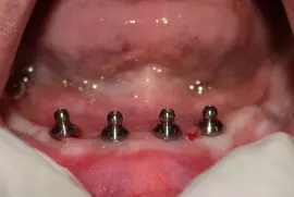 immediately after placing implants