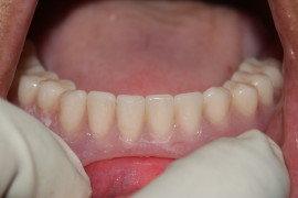 after denture