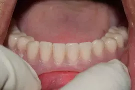 after denture