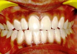 bleaching-after