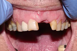 Cosmetic Treatment of Teeth In Ahmedabad - Case Photo 2