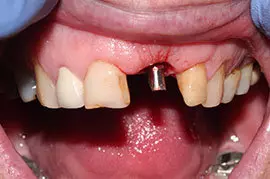Cosmetic Treatment of Teeth In Ahmedabad - Case Photo 3
