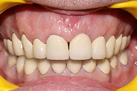 Cosmetic Treatment of Teeth In Ahmedabad - Case Photo 4