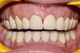 Cosmetic Treatment of Teeth In Ahmedabad - Case Photo 5