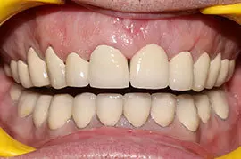 Cosmetic Treatment of Teeth In Ahmedabad - Case Photo 5
