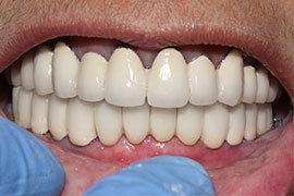Dental Implant In Ahmedabad Treatment 3