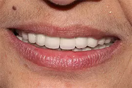 Digital Smile Design