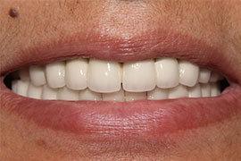 Dental Implant In Ahmedabad Treatment 6