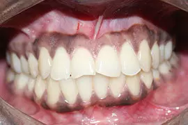 Dental Laser Treatment Ahmedabad - Case Photo 1