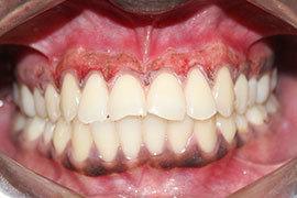 Dental Laser Treatment Ahmedabad - Case Photo 2
