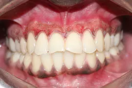 Dental Laser Treatment Ahmedabad - Case Photo 2