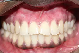 Dental Laser Treatment Ahmedabad - Case Photo 3