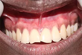 Dental Laser Treatment Ahmedabad - Case Photo 4