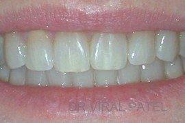 before whitening