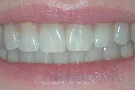 before whitening