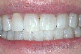 after bleaching