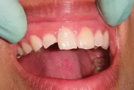 Before veneers
