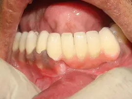 After Teeth Replacement