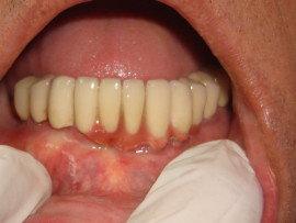 after treatment