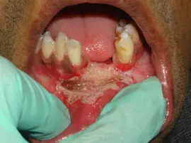 immediate after lasers