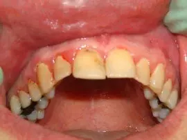 Before Laser Surgery