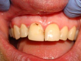 After Laser Flap Surgeries