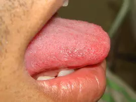Tongue Tie