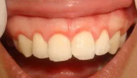 after healing