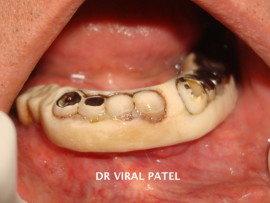 mobile implants & bridge