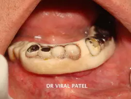 mobile implants & bridge