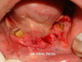 infection around implants