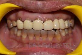 before smile makeover