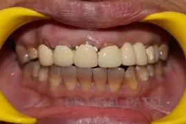 before smile makeover