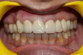 after smile makeover