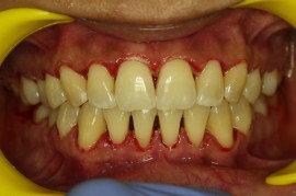 Laser Gum Surgery