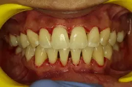 Laser Gum Surgery