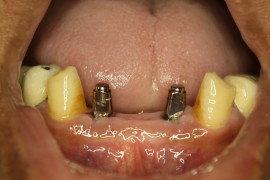 After Healing