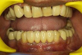 Final Bridge On Implants