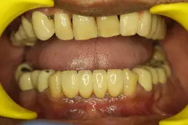 Final Bridge On Implants