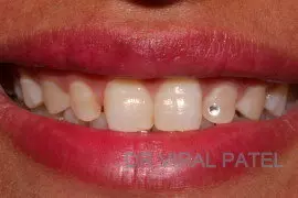 tooth diamond