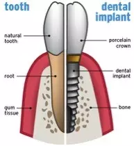 tooth implant ahmedabad